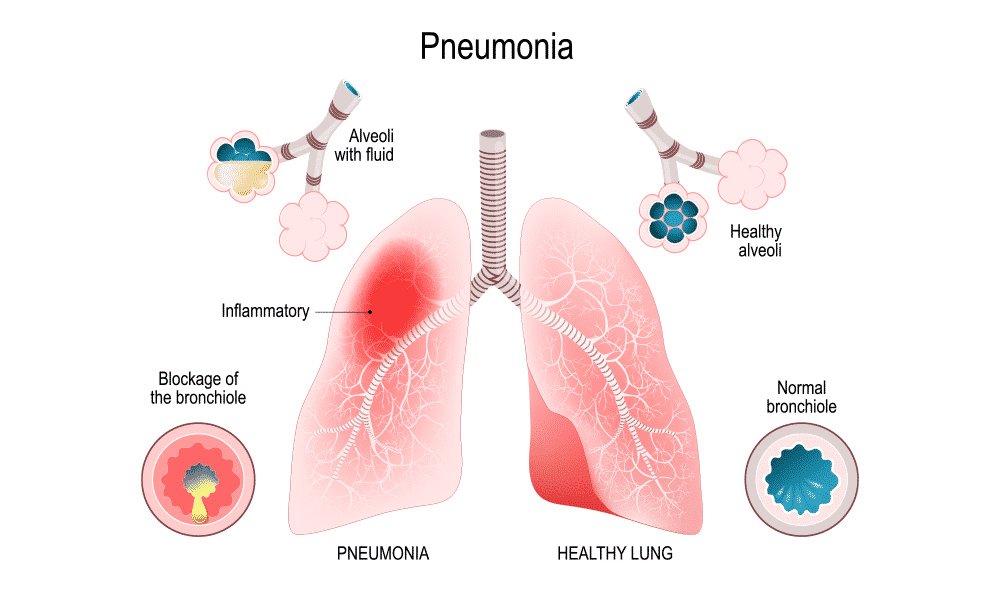 pippalyasavam-for-cough