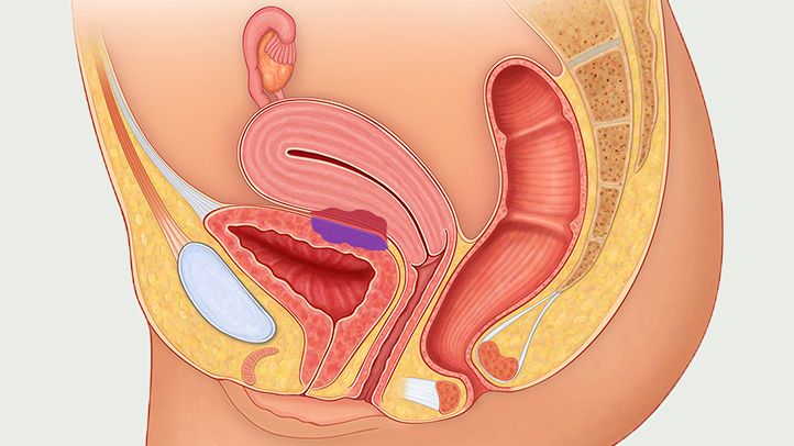 saptasaram-kashayam-for-endometriosis